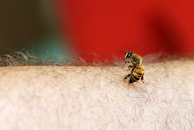 Bee Sting Allergy